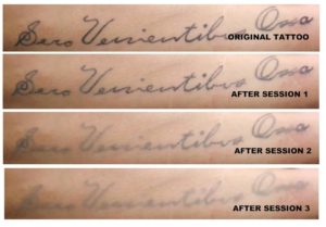 Tattoo-Removal