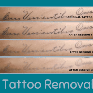 Online Tattoo Removal Course
